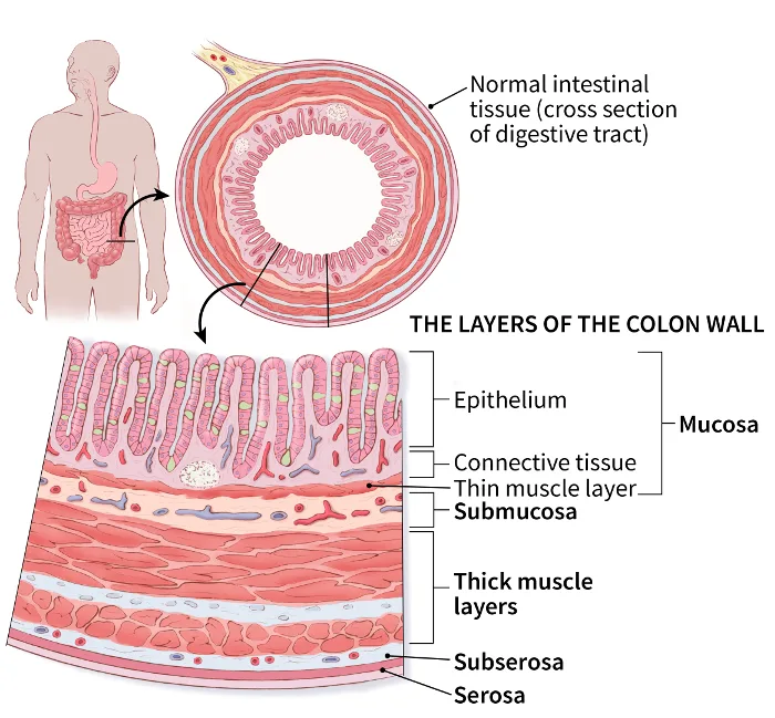 Colorectal Cancer